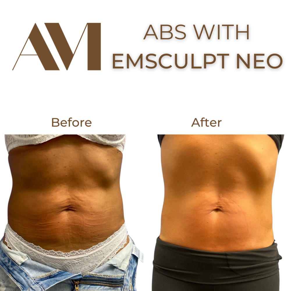 EMSculpt Neo Before & After Image