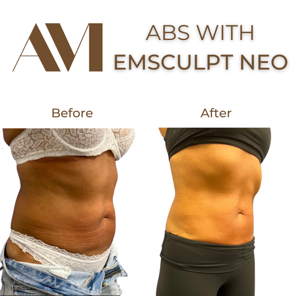 EMSculpt Neo Before & After Image