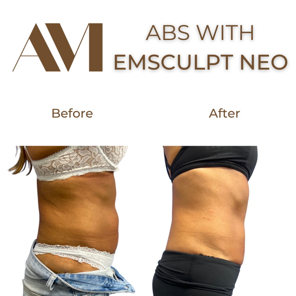 EMSculpt Neo Before & After Image