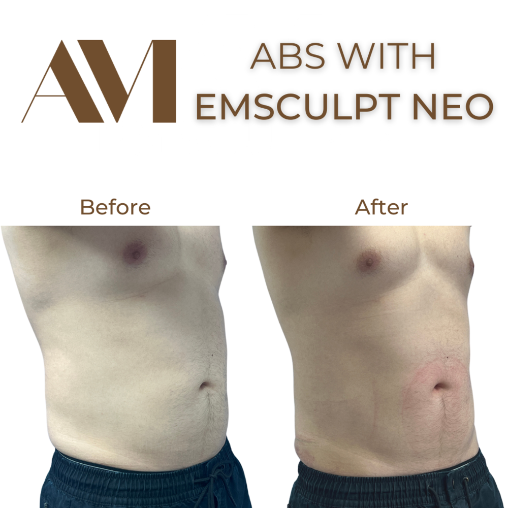 EMSculpt Neo Before & After Image