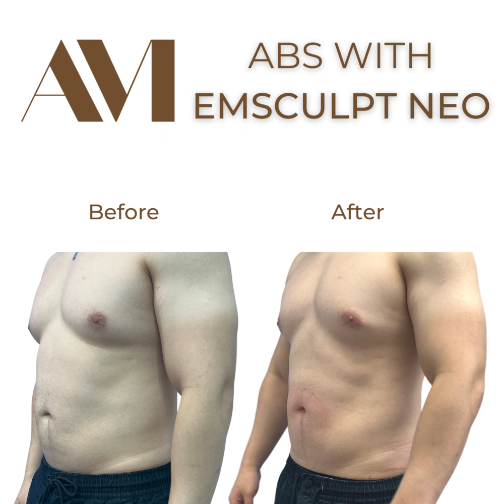 EMSculpt Neo Before & After Image