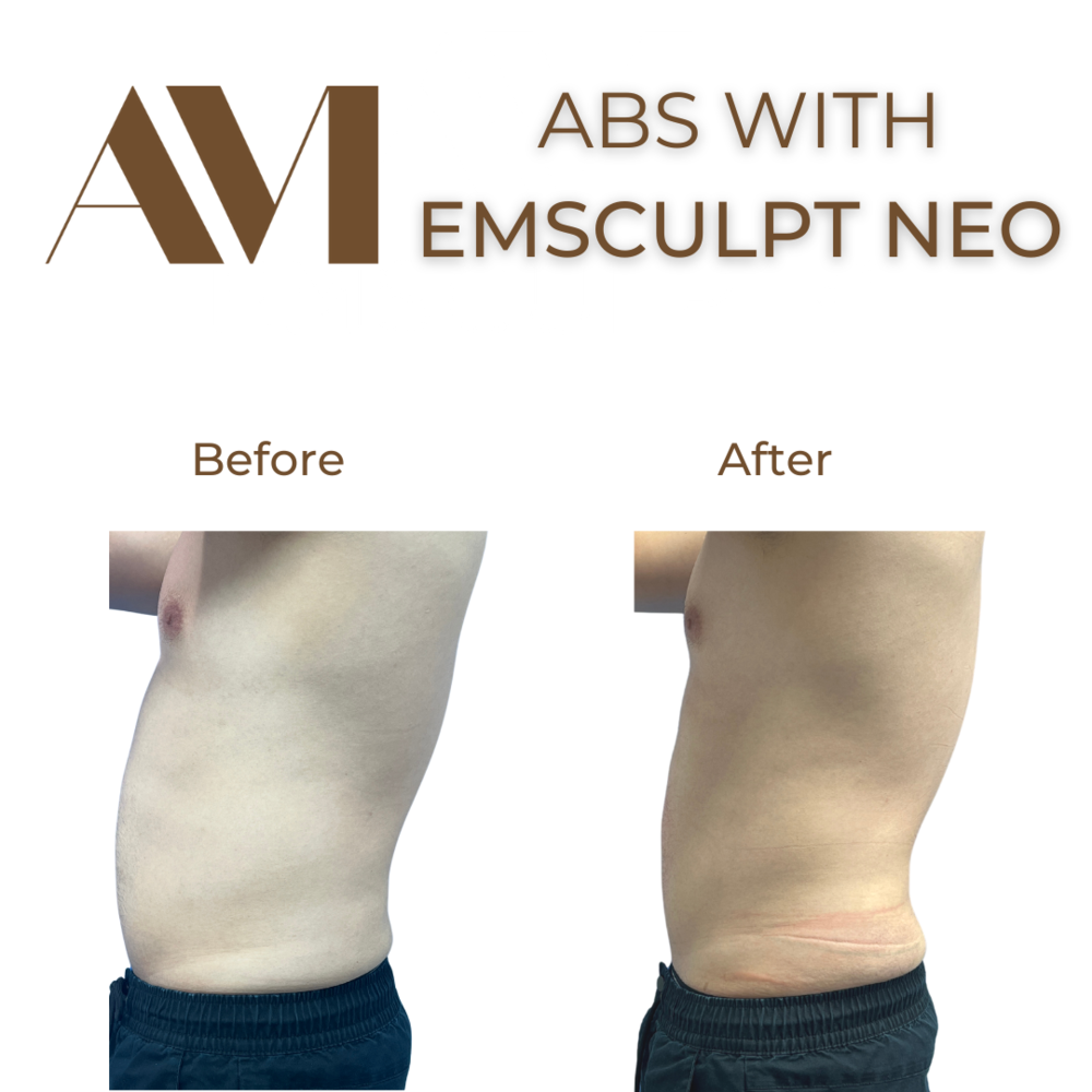 EMSculpt Neo Before & After Image