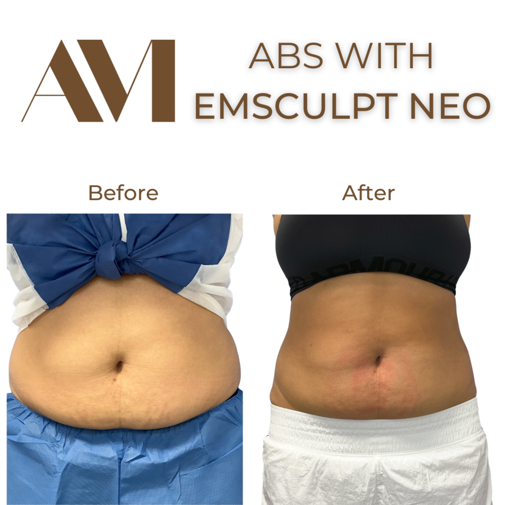 EMSculpt Neo Before & After Image