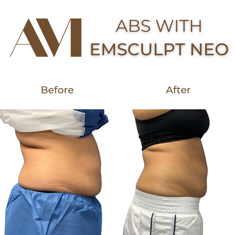 EMSculpt Neo Before & After Image