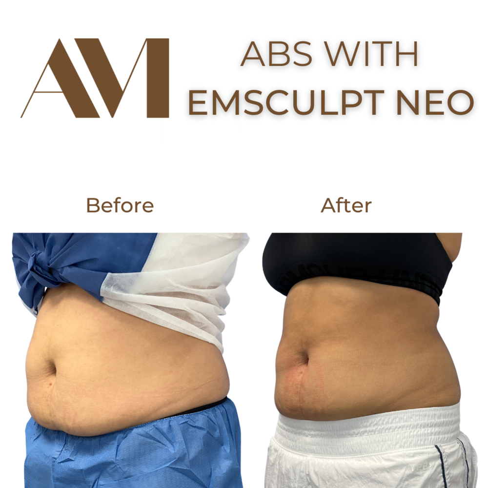 EMSculpt Neo Before & After Image