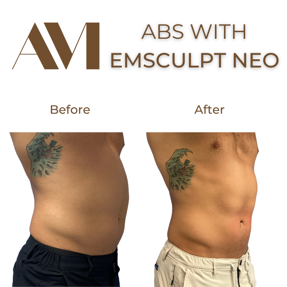 EMSculpt Neo Before & After Image
