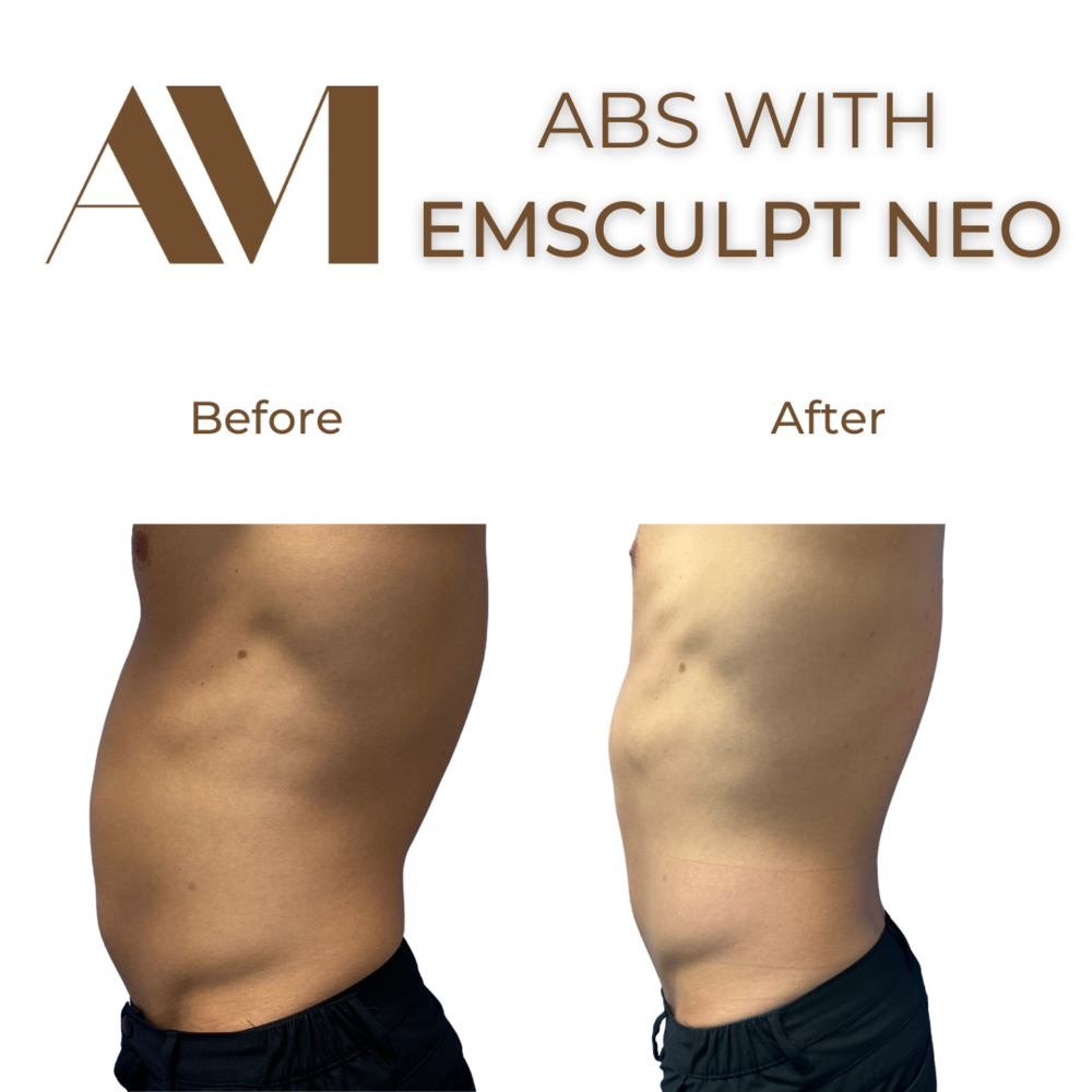 EMSculpt Neo Before & After Image