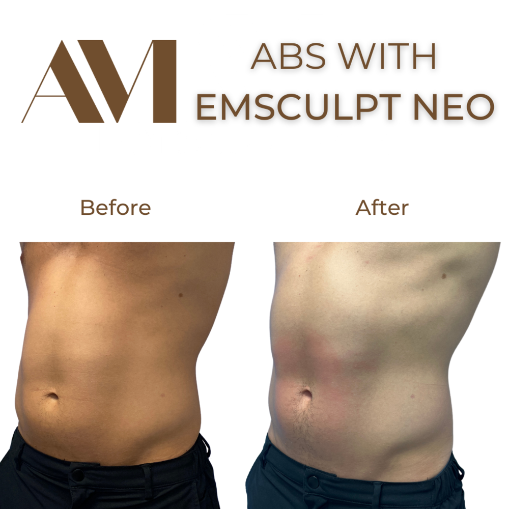 EMSculpt Neo Before & After Image