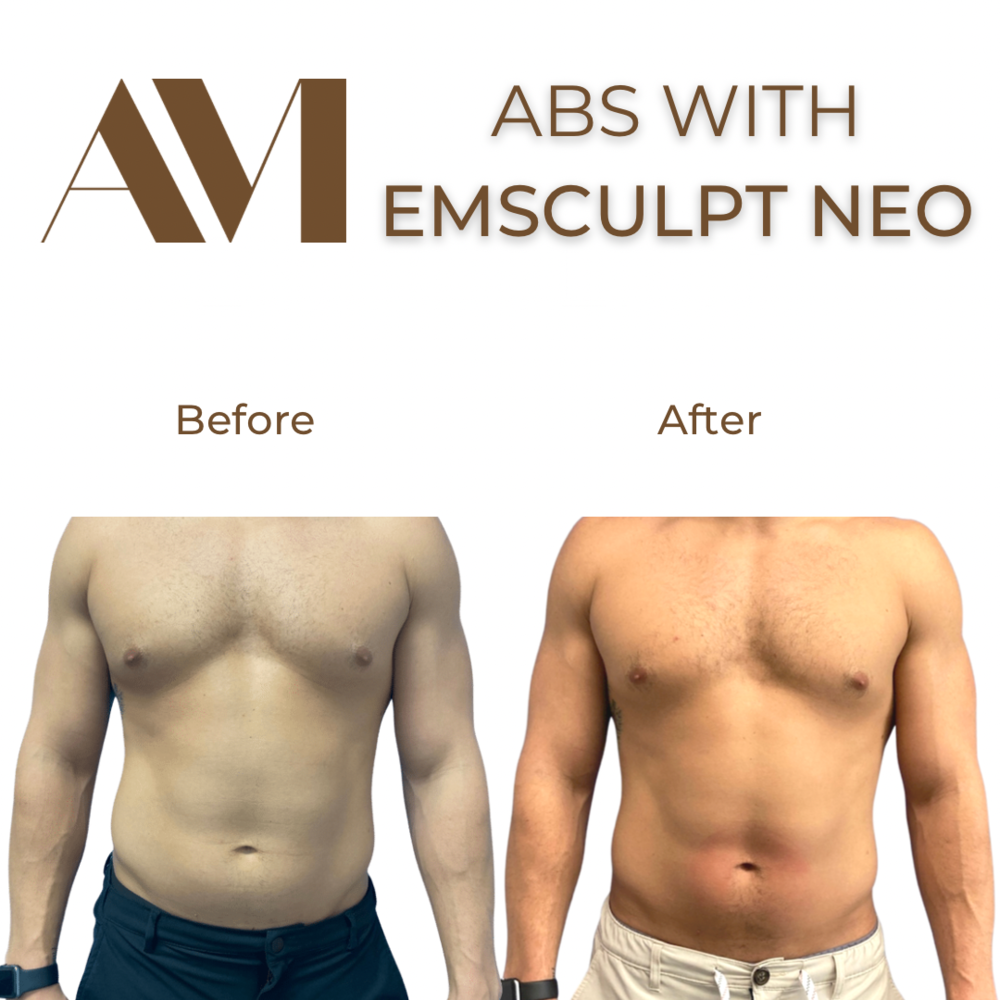 EMSculpt Neo Before & After Image