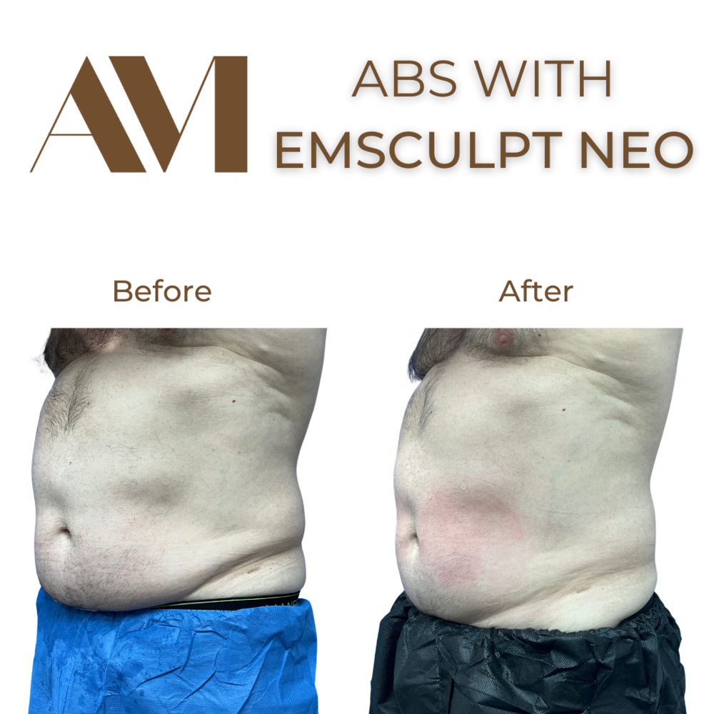 EMSculpt Neo Before & After Image