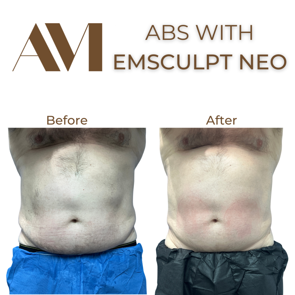 EMSculpt Neo Before & After Image