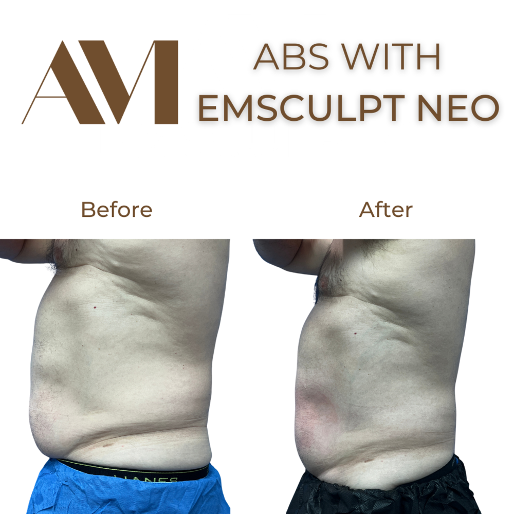 EMSculpt Neo Before & After Image