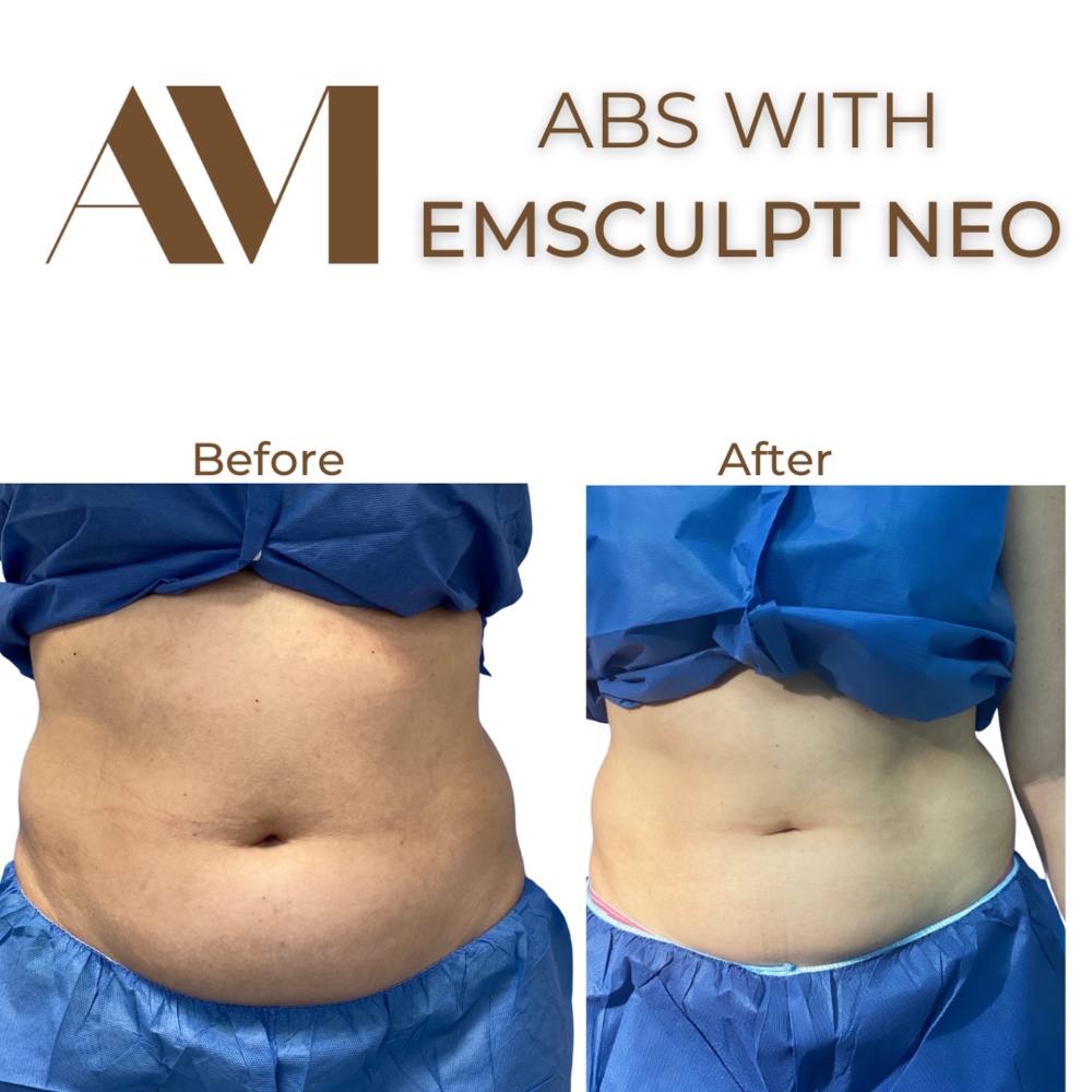 EMSculpt Neo Before & After Image