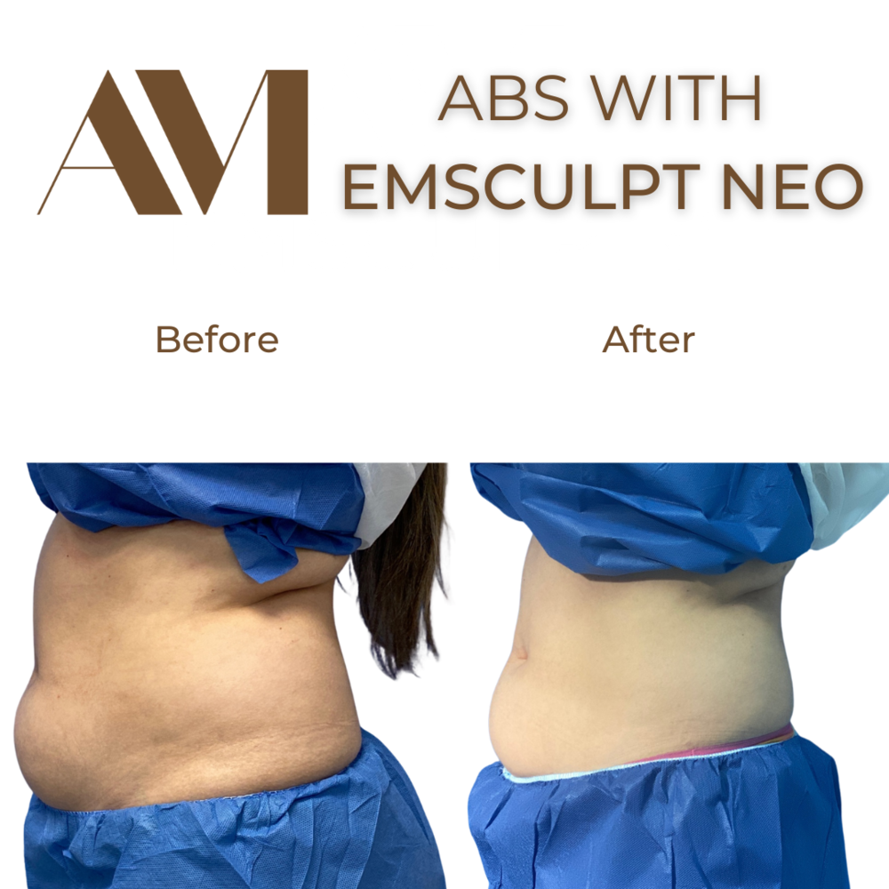 EMSculpt Neo Before & After Image