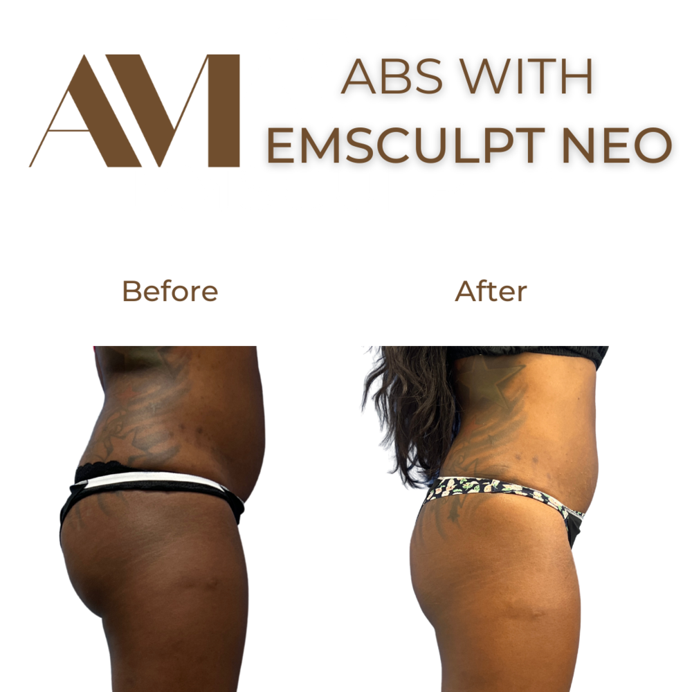 EMSculpt Neo Before & After Image