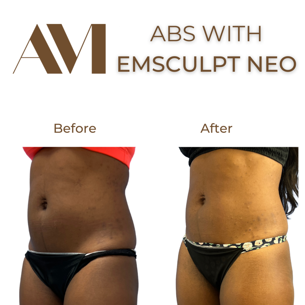 EMSculpt Neo Before & After Image