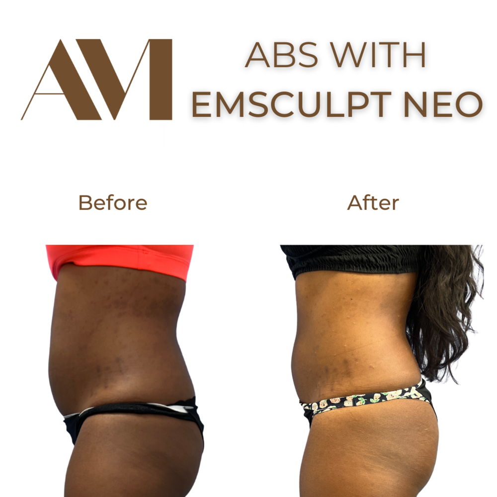 EMSculpt Neo Before & After Image